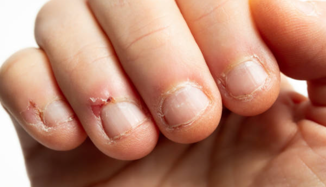 Twenty Years of Nail Biting: Why You're Not a Lost Cause